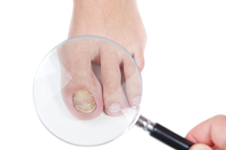 皮肤科医生检查的真菌，湿疹存在的指甲上。 （fotolia）